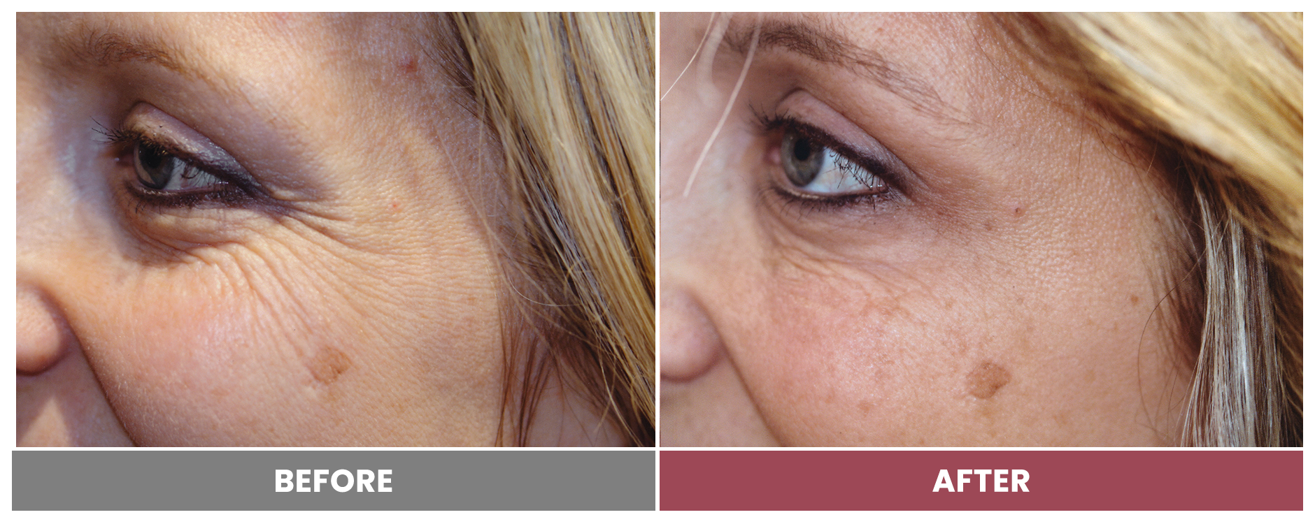 BOTOX FOR WRINKLES & BROW LIFT - Case 5